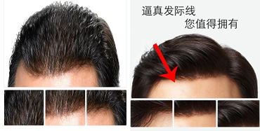 发际线后移