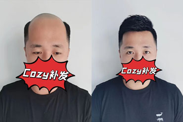 长春兄弟无痕补发后找回来那些年遗失的头发