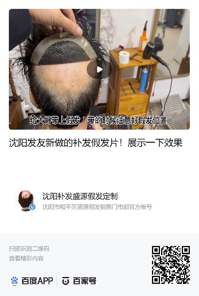 沈阳补发假发效果展示